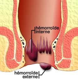 hémorroïde externe